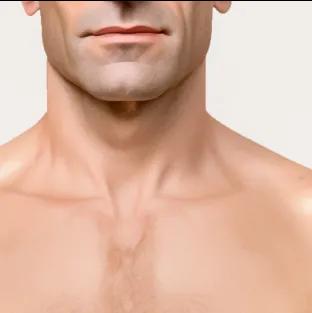 Fitzpatrick skin type II