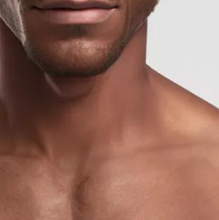 Fitzpatrick skin type V